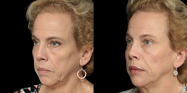 Facial Filler Before & After