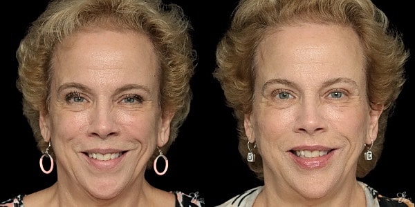 Facial Filler Before & After
