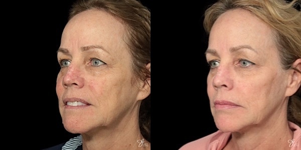 Facial Filler Before & After