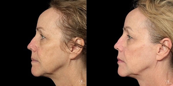 Facial Filler Before & After