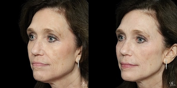 Facial Filler Before & After