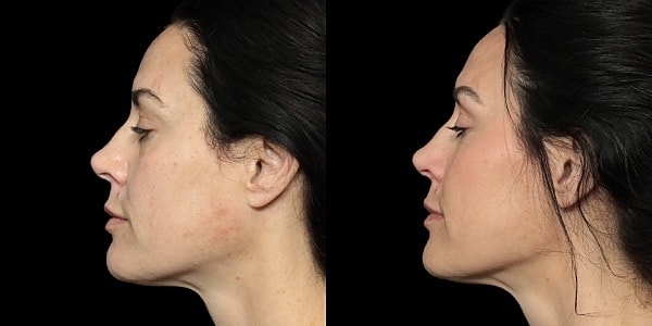 Facial Filler Before & After