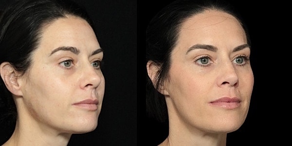 Facial Filler Before & After