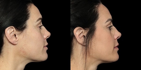 Facial Filler Before & After