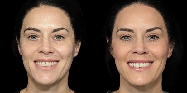 Facial Filler Before & After