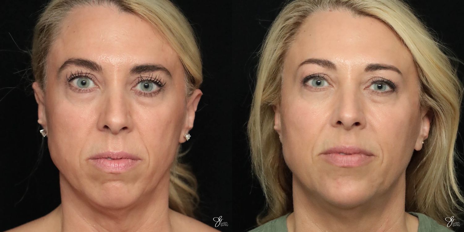 Facial Filler Before & After