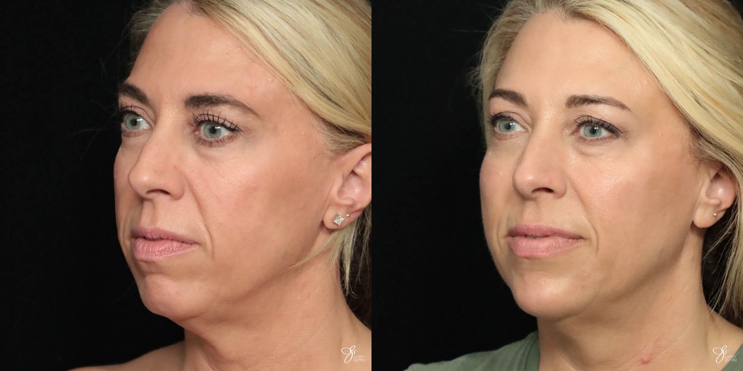 Facial Filler Before & After
