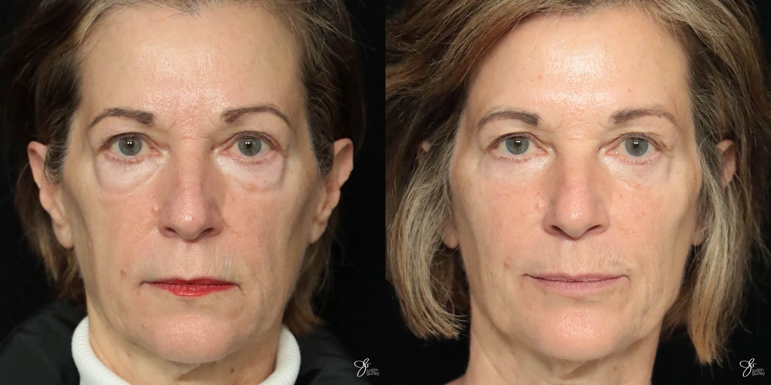 Facial Filler Before & After