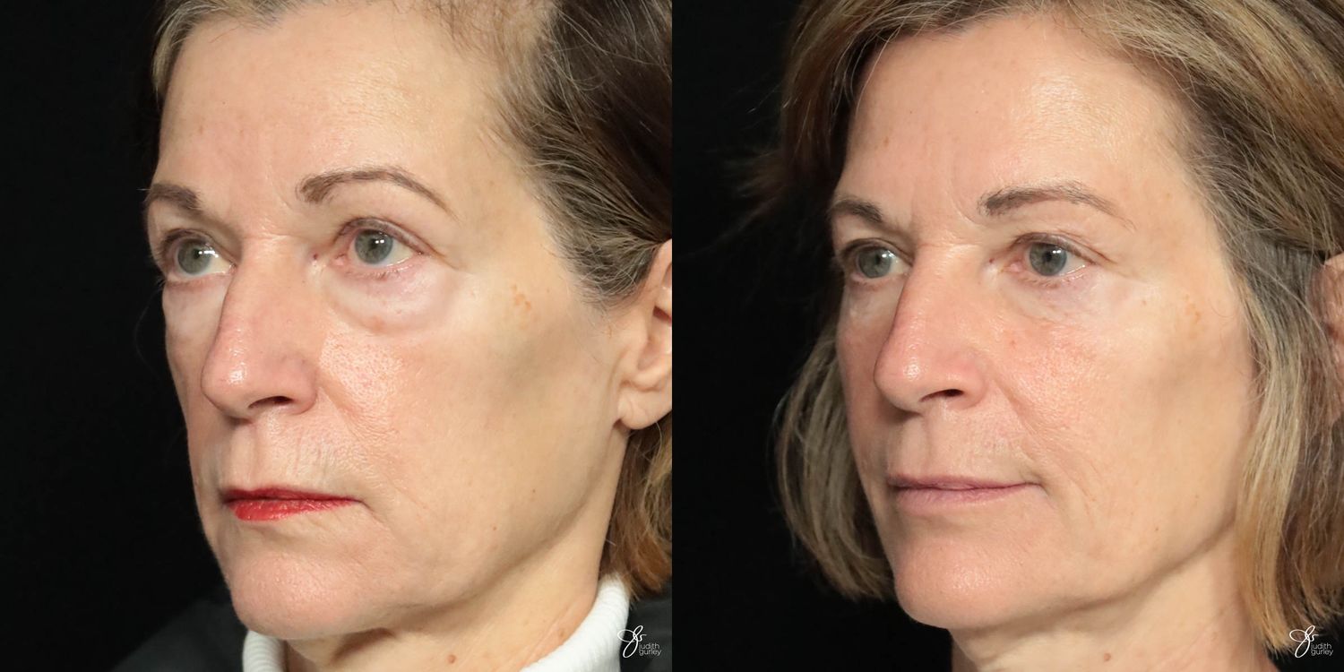 Facial Filler Before & After