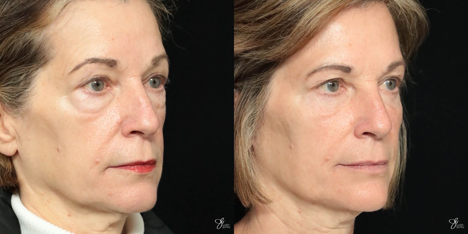 Facial Filler Before & After