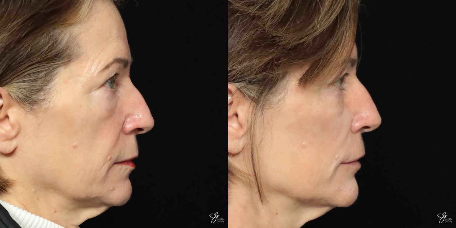 Facial Filler Before & After