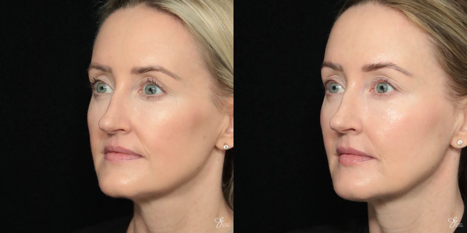 Facial Filler Before & After