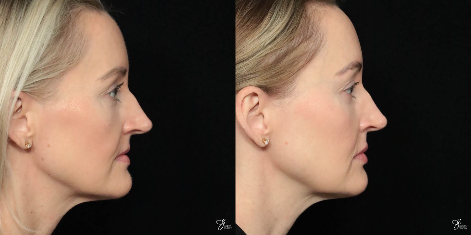 Facial Filler Before & After