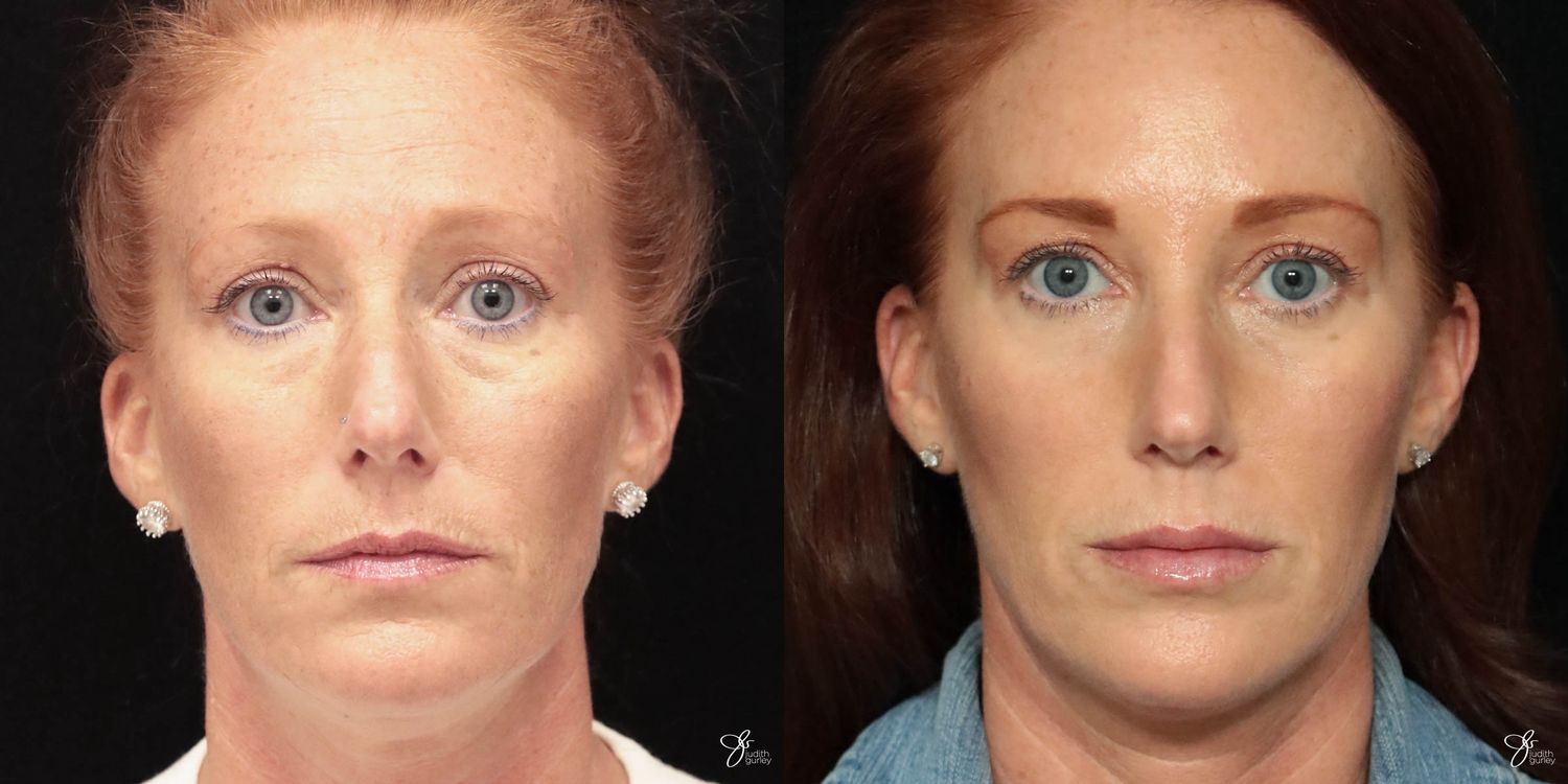 Facial Filler Before & After