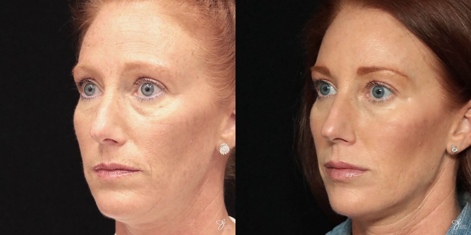 Facial Filler Before & After