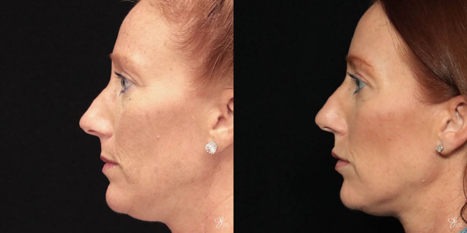 Facial Filler Before & After