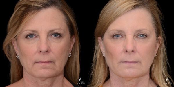 Facial Filler Before & After