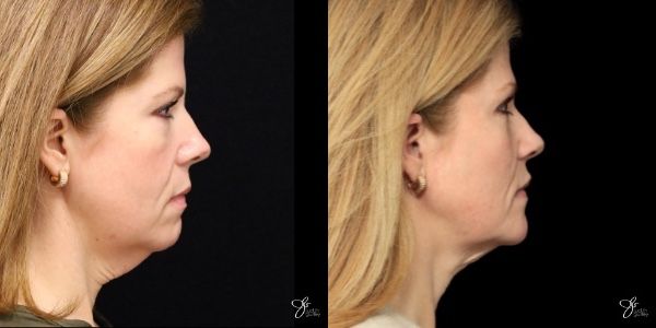 Facial Filler Before & After