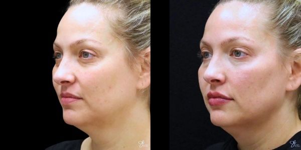 Facial Filler Before & After