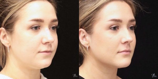 Facial Filler Before & After