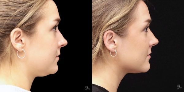 Facial Filler Before & After