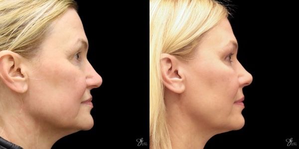 Facial Filler Before & After