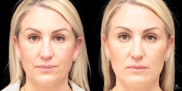Facial Filler Before & After