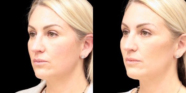 Facial Filler Before & After