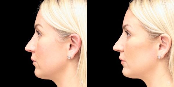 Facial Filler Before & After