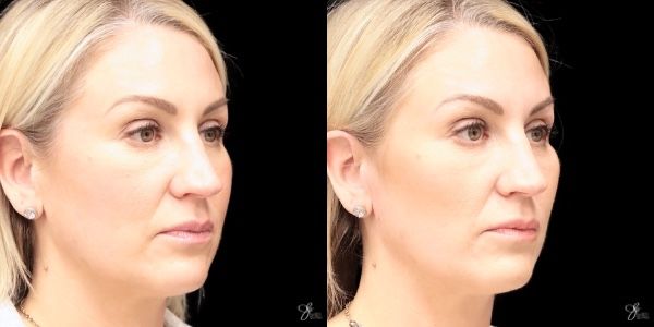 Facial Filler Before & After