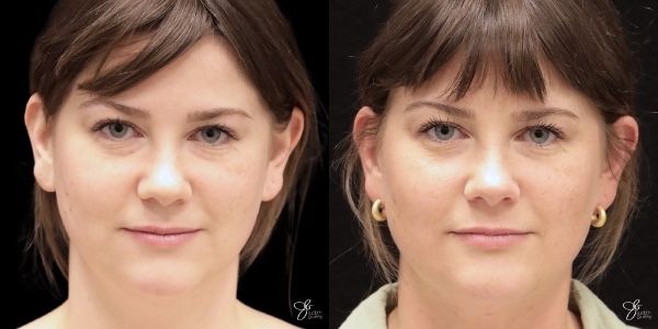 Facial Filler Before & After