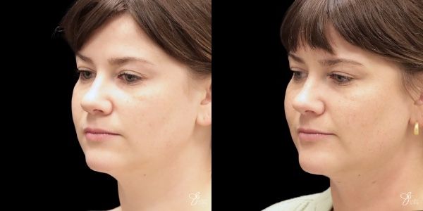 Facial Filler Before & After