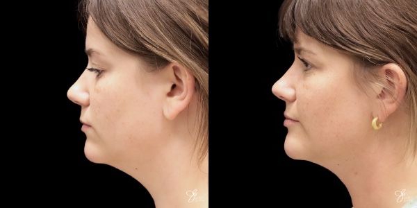 Facial Filler Before & After