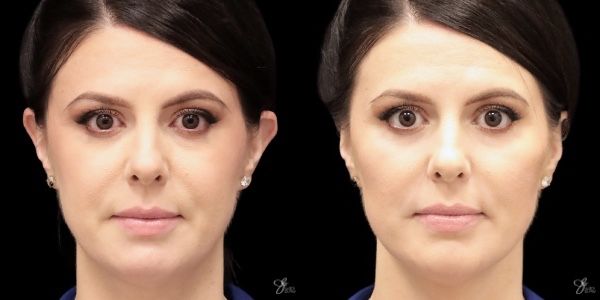Facial Filler Before & After