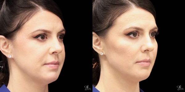 Facial Filler Before & After