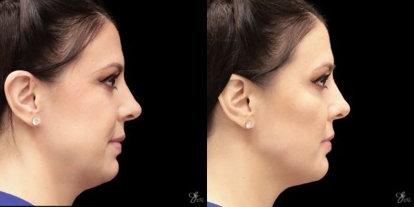Facial Filler Before & After
