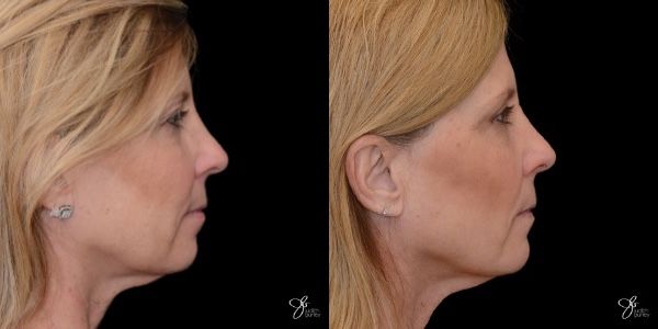 Facial Filler Before & After