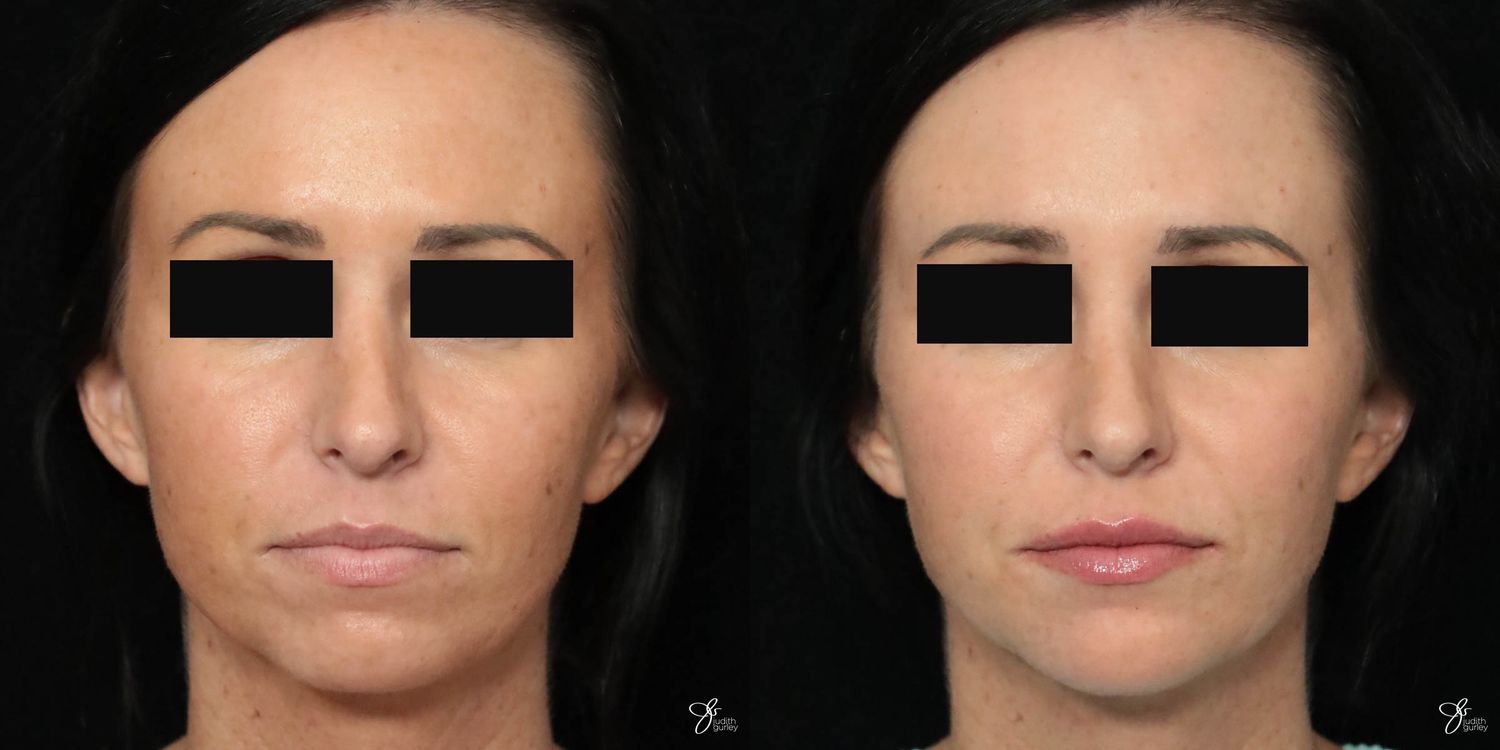 Facial Filler Before & After