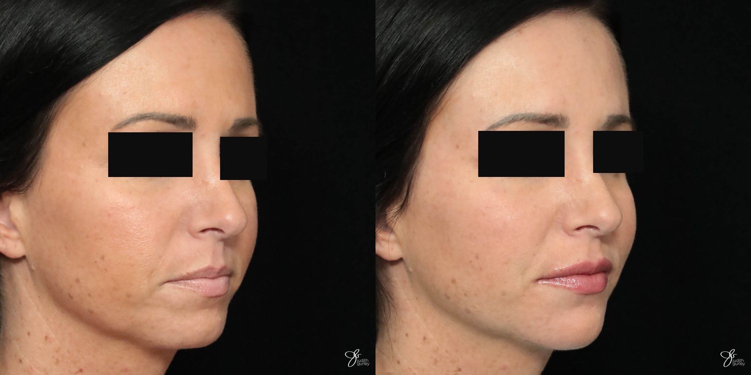 Facial Filler Before & After