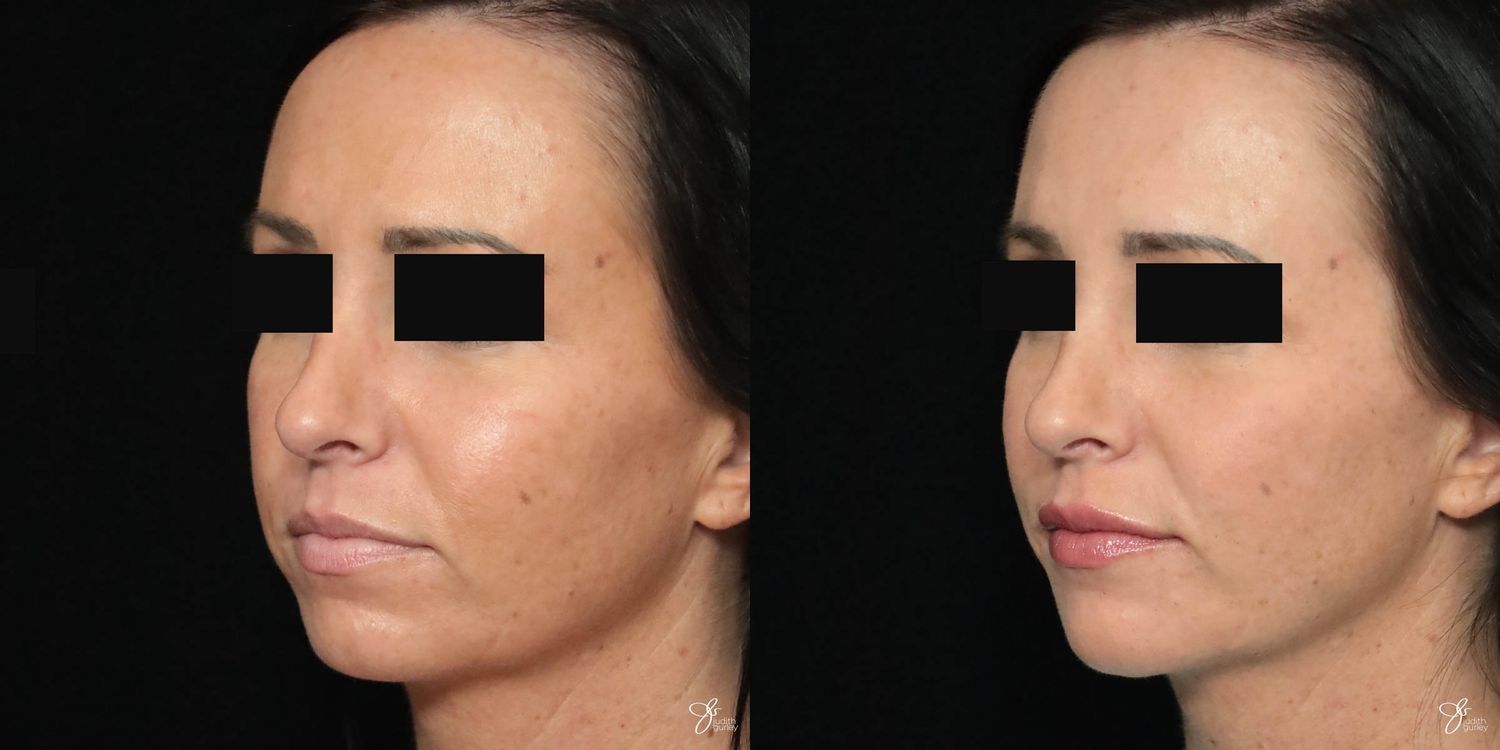 Facial Filler Before & After