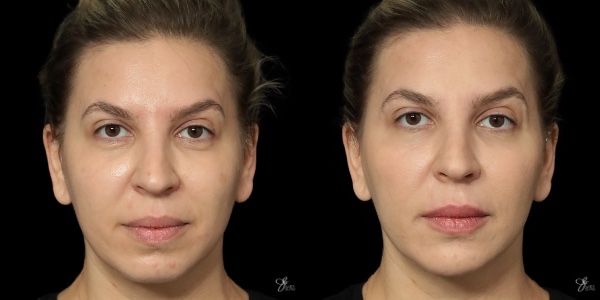 Facial Filler Before & After