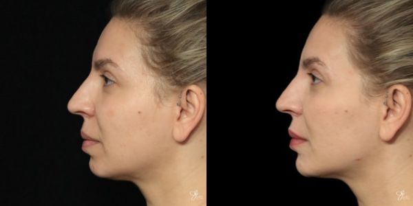 Facial Filler Before & After