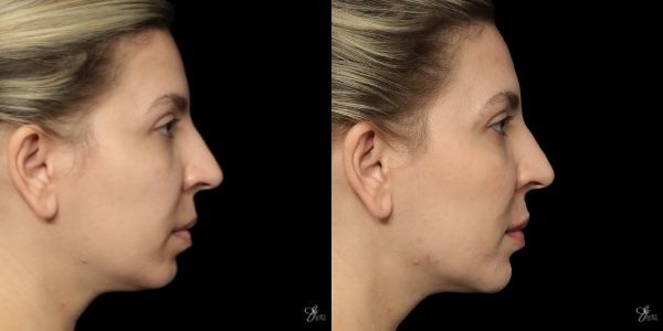 Facial Filler Before & After
