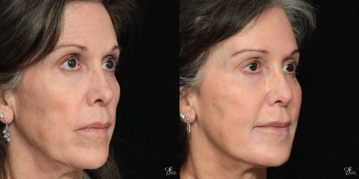 Facial Filler Before & After