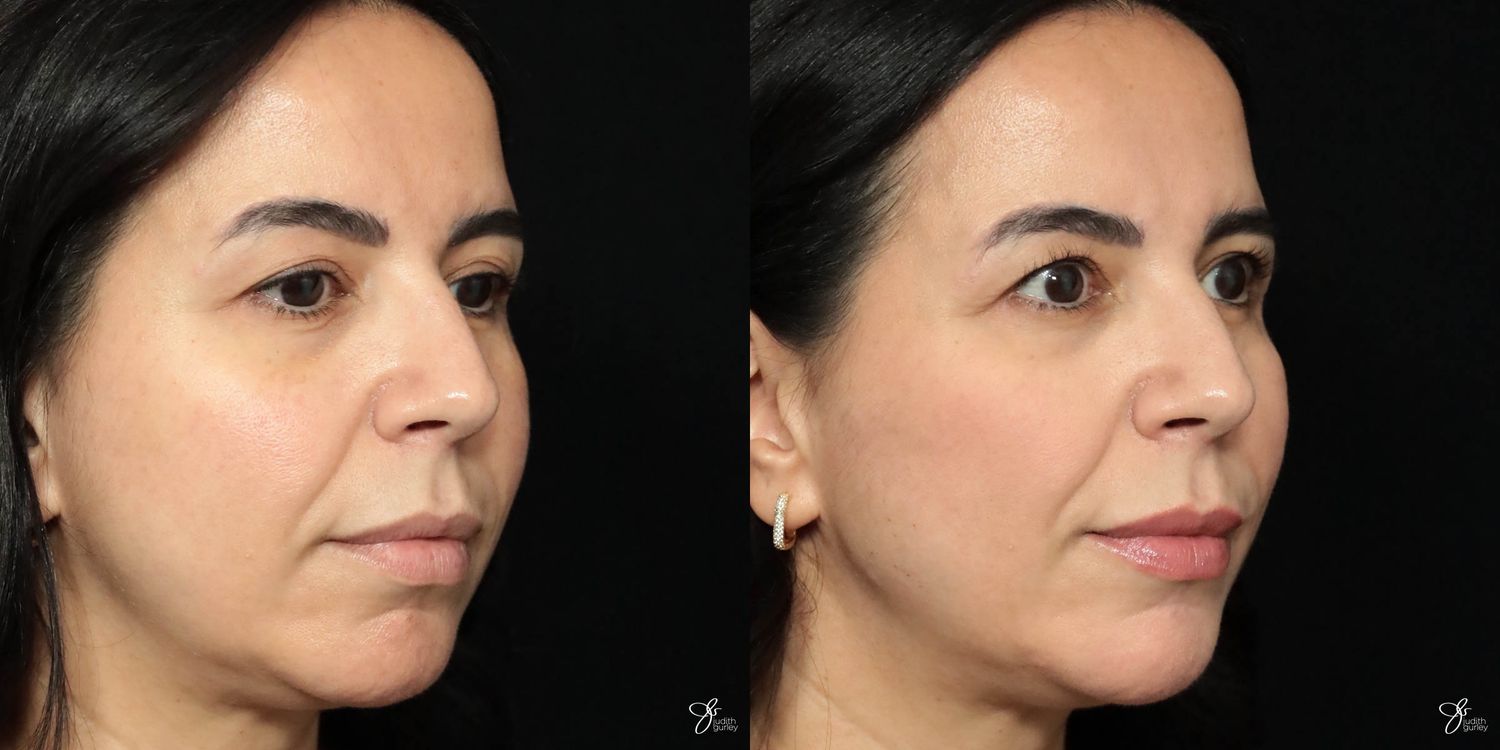 Facial Filler Before & After