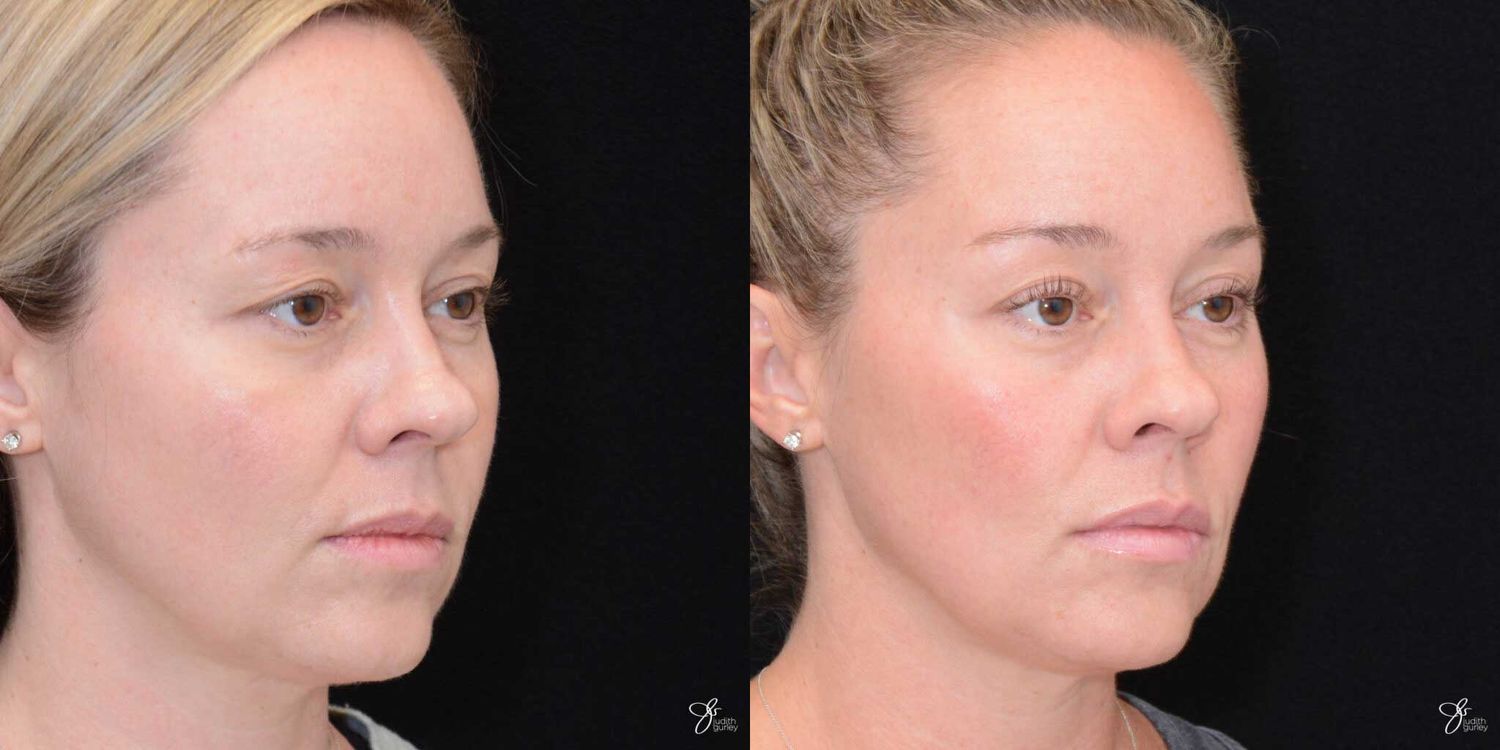 Facial Filler Before & After