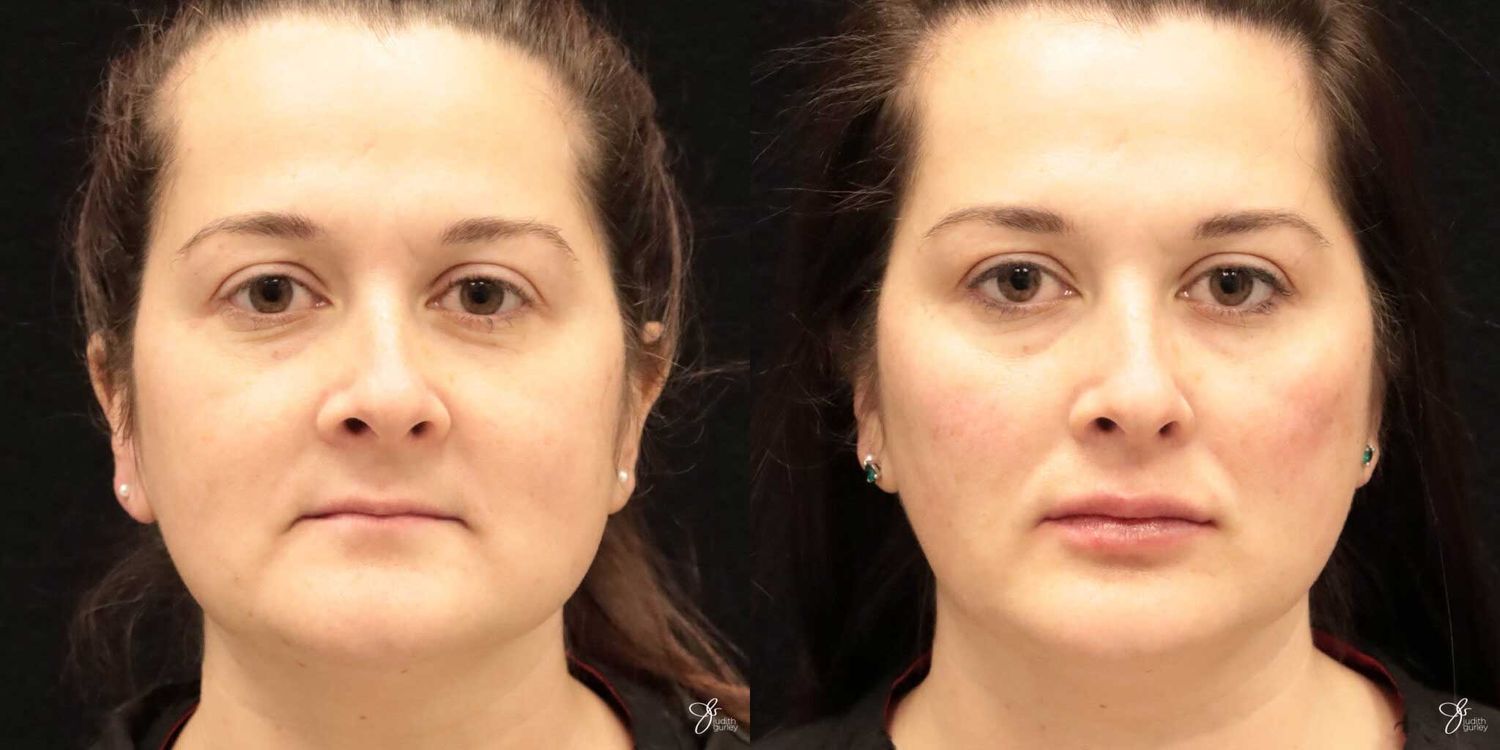 Facial Filler Before & After