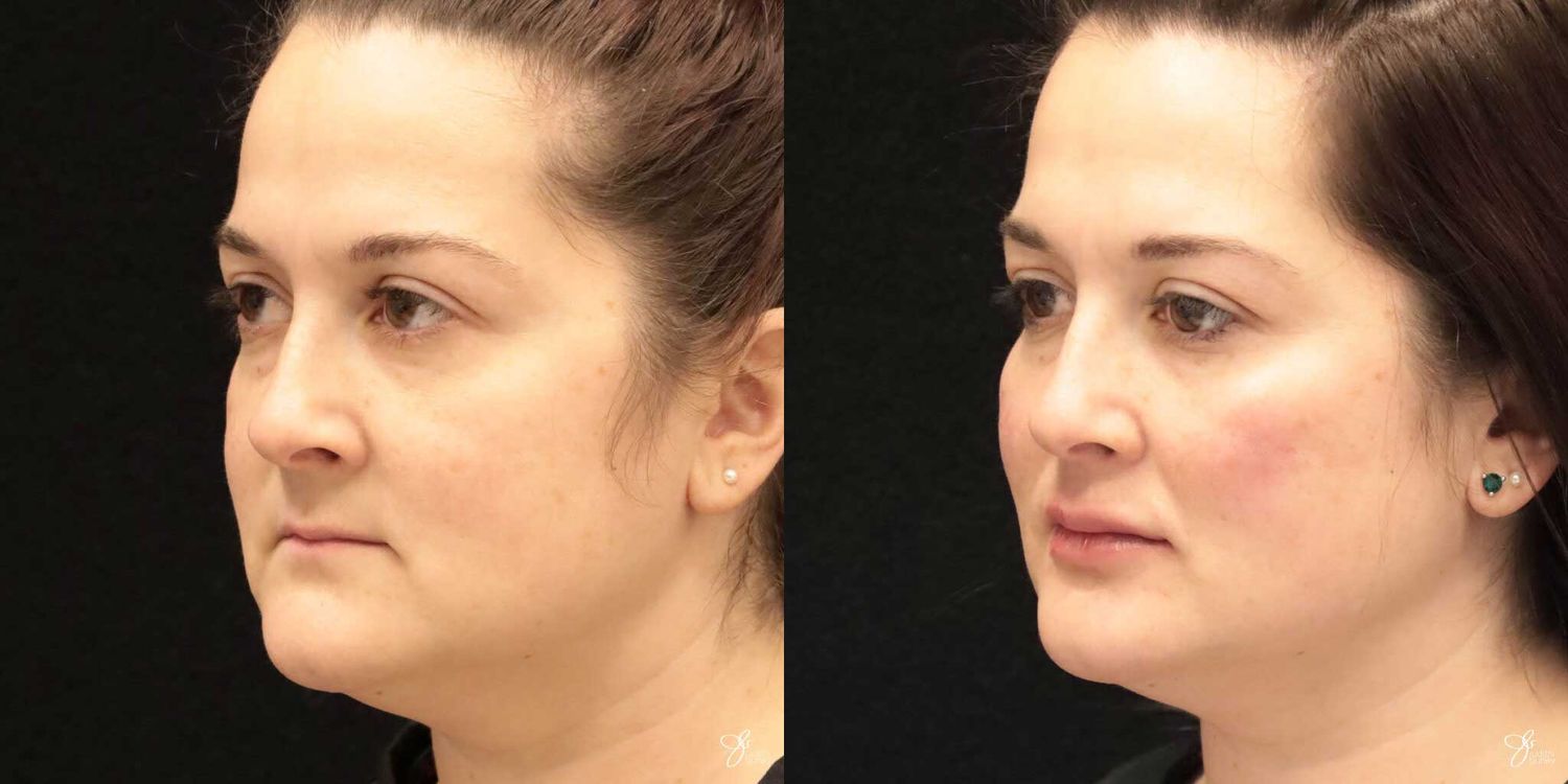 Facial Filler Before & After