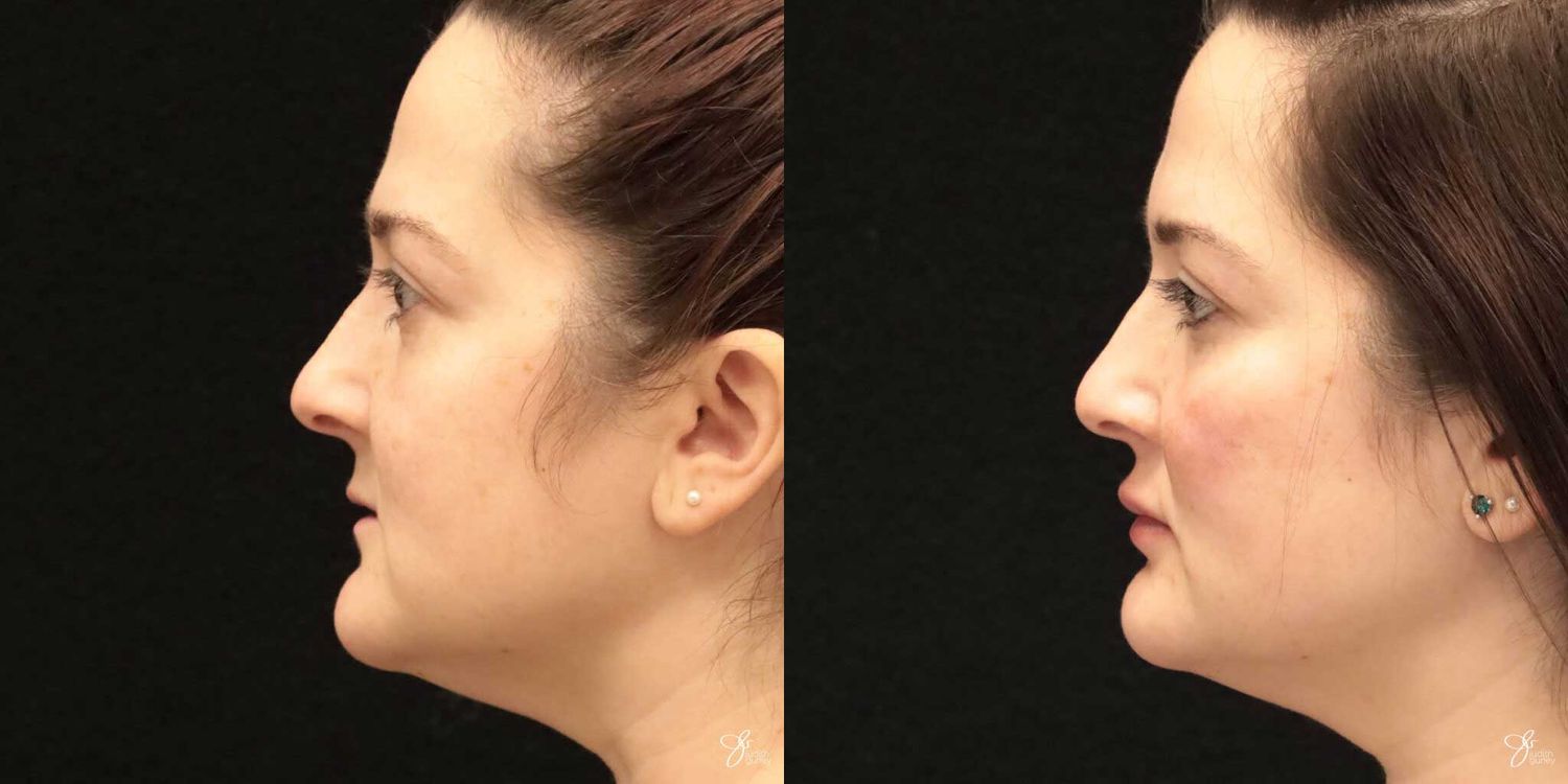 Facial Filler Before & After