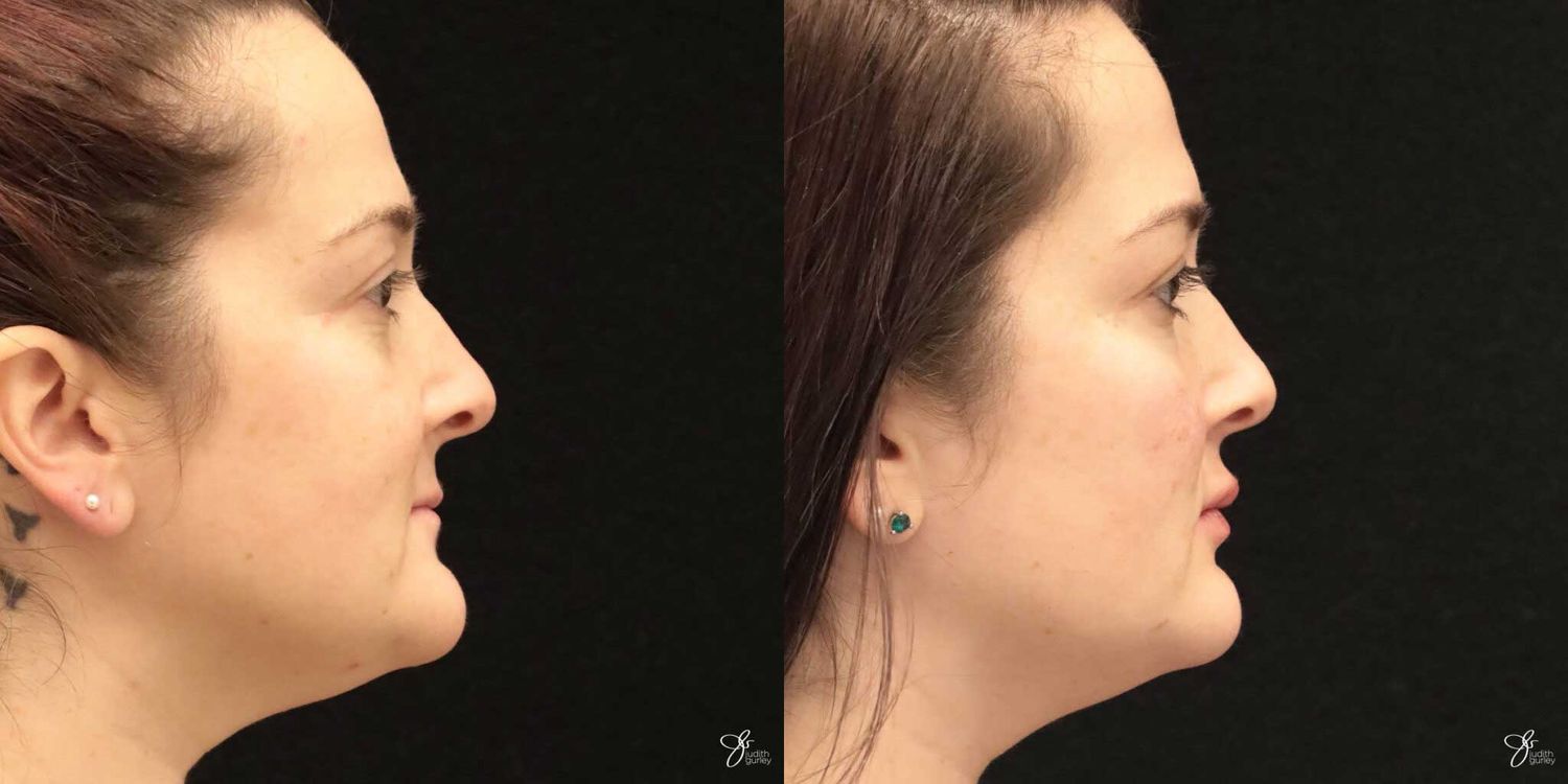 Facial Filler Before & After